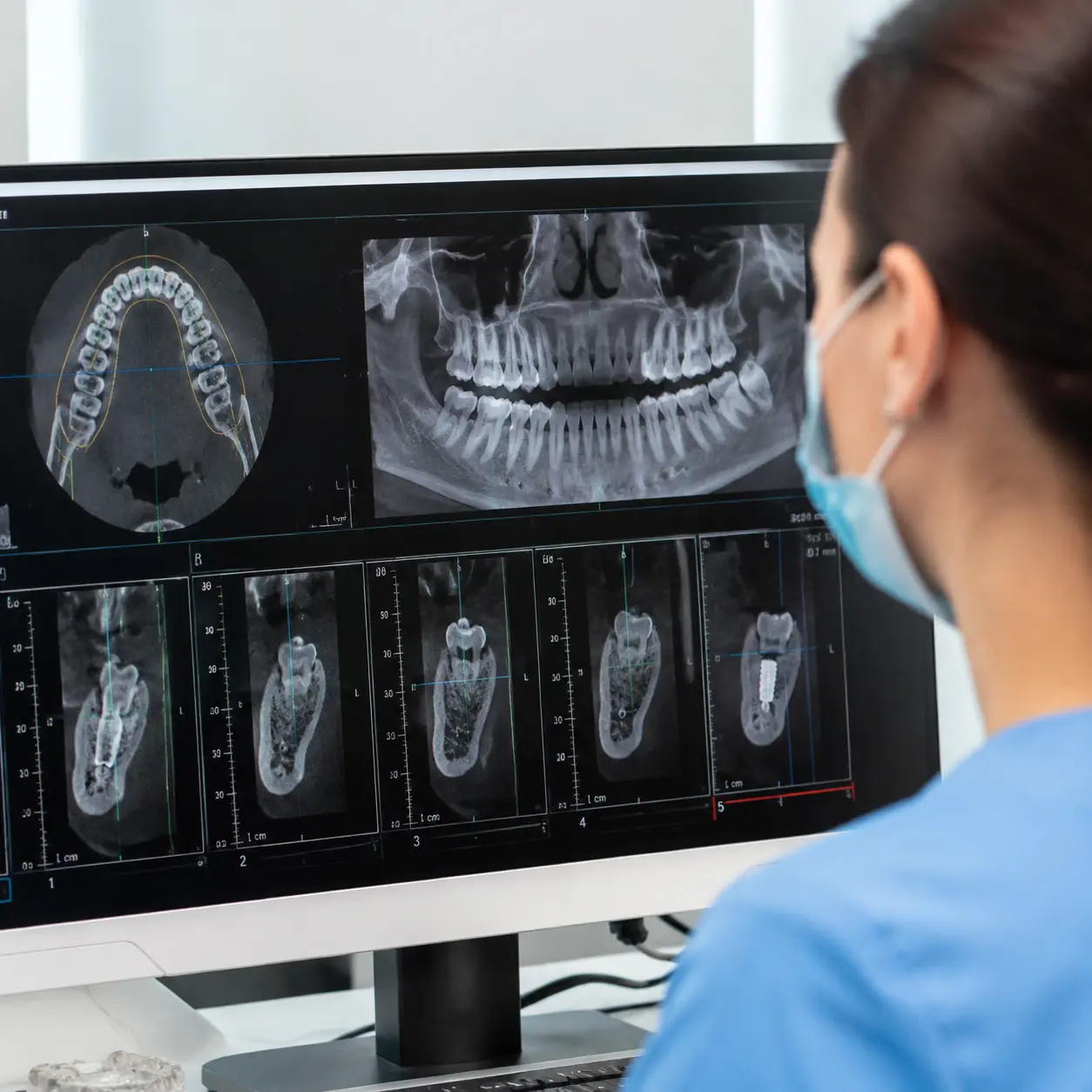 CBCT برای ایمپلنت فوری در رشت
