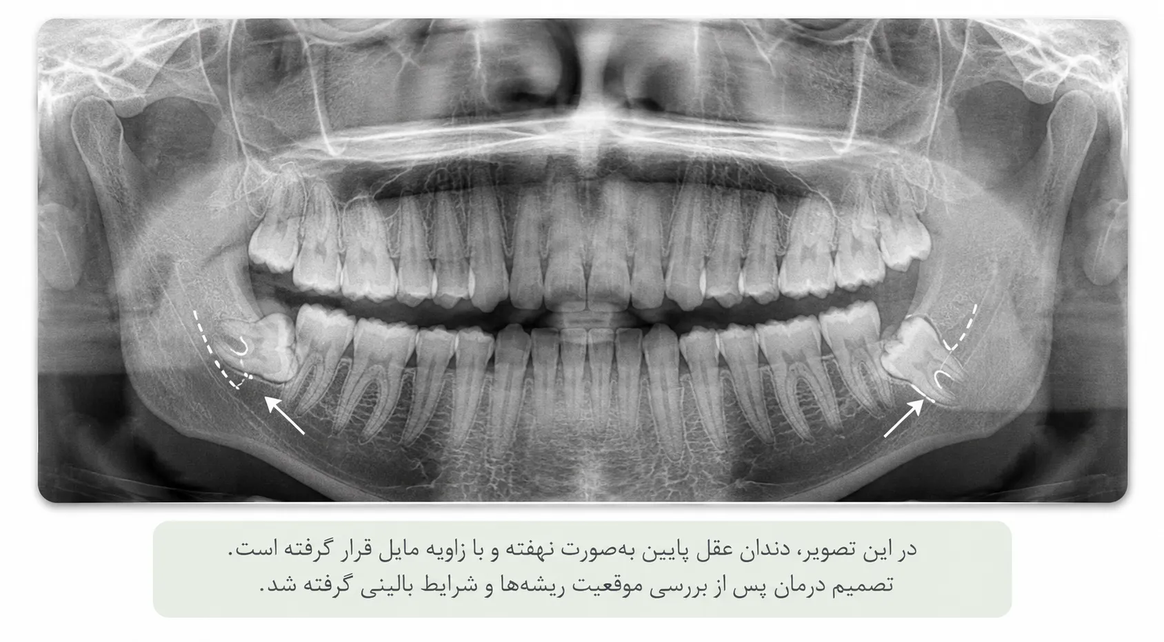 جراحی دندان عقل در رشت