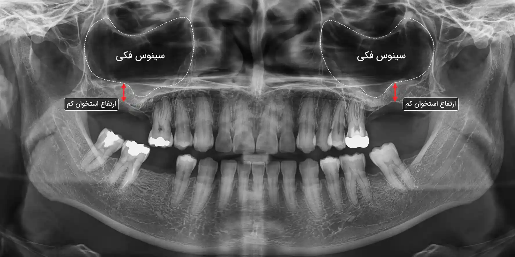 سینوس لیفت چیست؟مطب دندانپزشکی دکتر عطاران