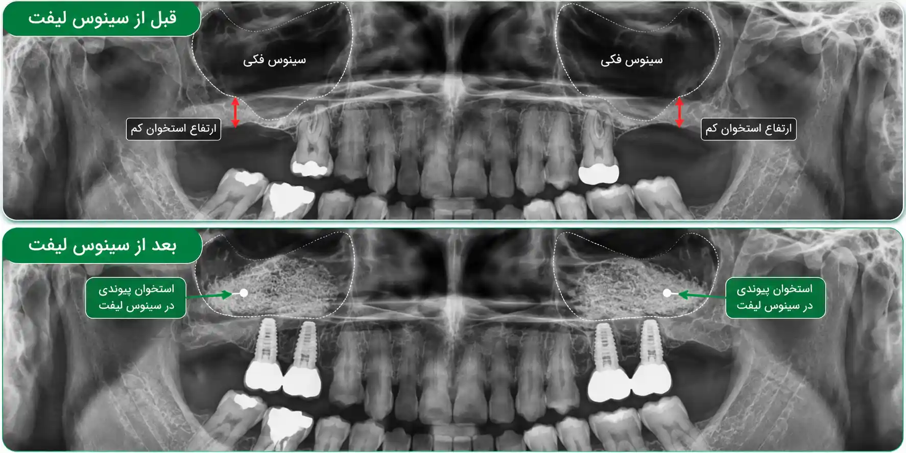 عوارض جراحی سینوس لیفت در رشت