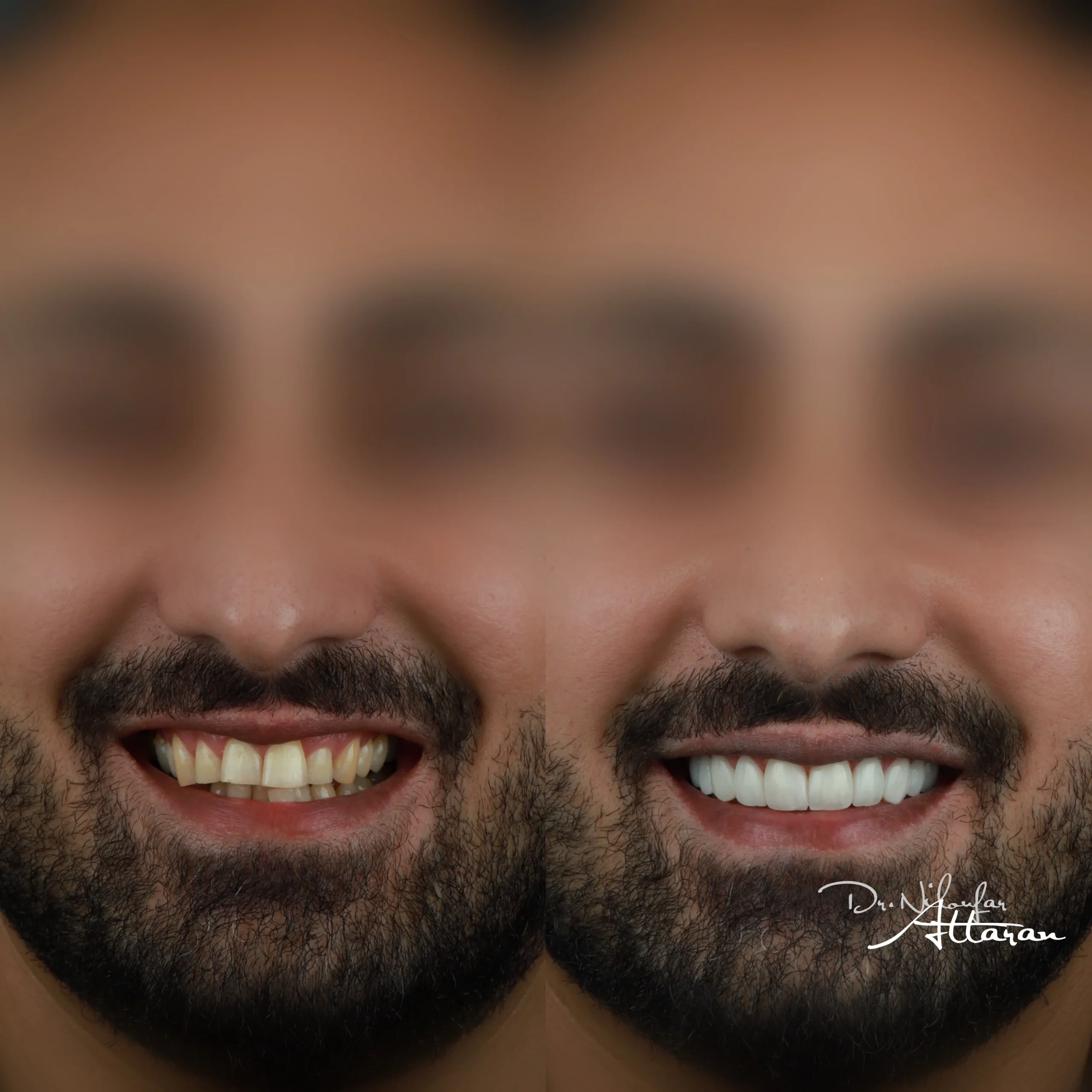 نمونه کار کامپوزیت دندان