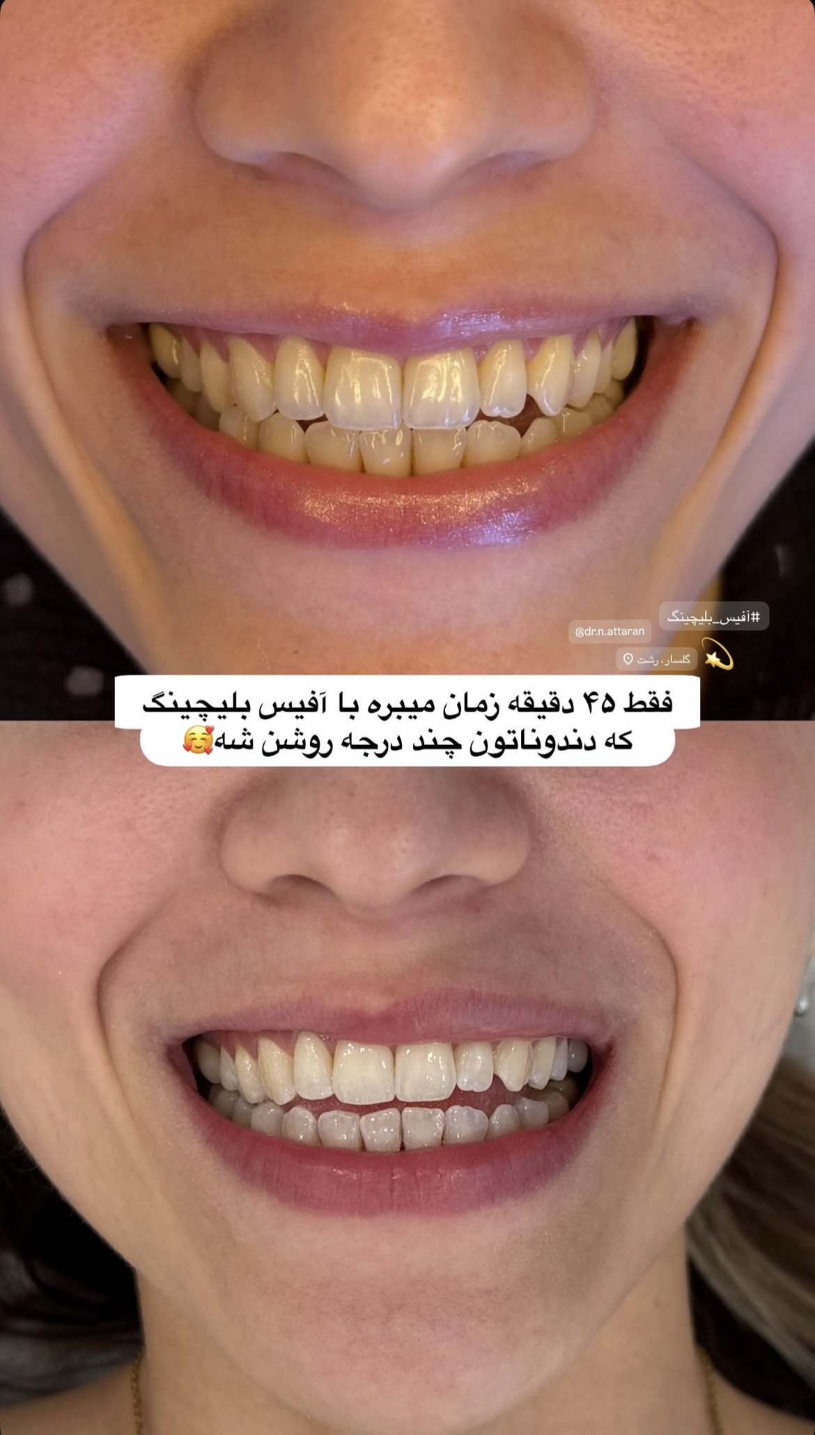 سفید کردن دندان یا بلیچینگ دندان در رشت