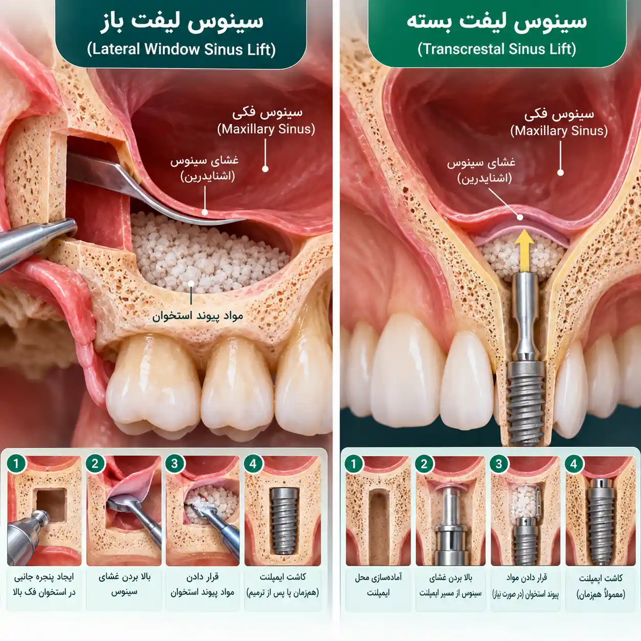 جراحی سینوس لیفت در رشت